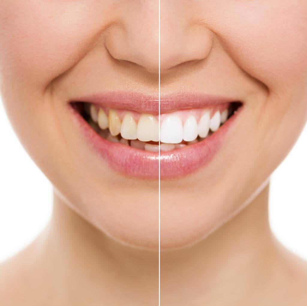 Clareamento dental
